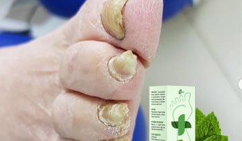Микоцел – средство от грибковых поражений кожи и ногтей